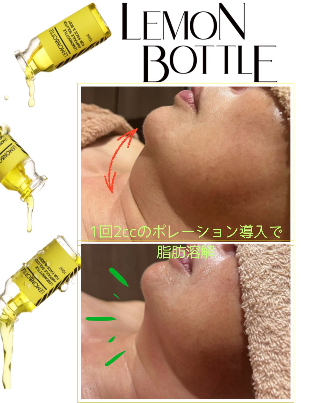脂肪溶解液　『レモンボトル』　はじめました