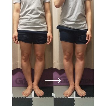 O脚矯正に力を入れております!!